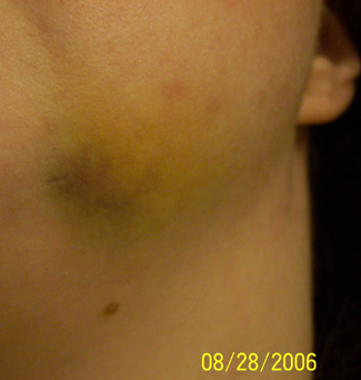 bruise.jpg