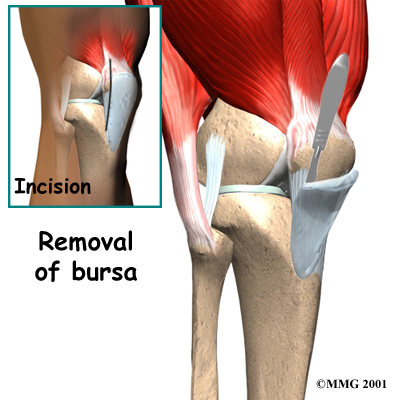 knee_prepatellar_surgery01.jpg