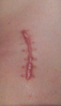 kneescar.jpg